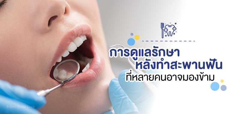 สะพานฟัน