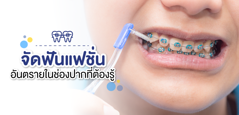 การจัดฟันแฟชั่น